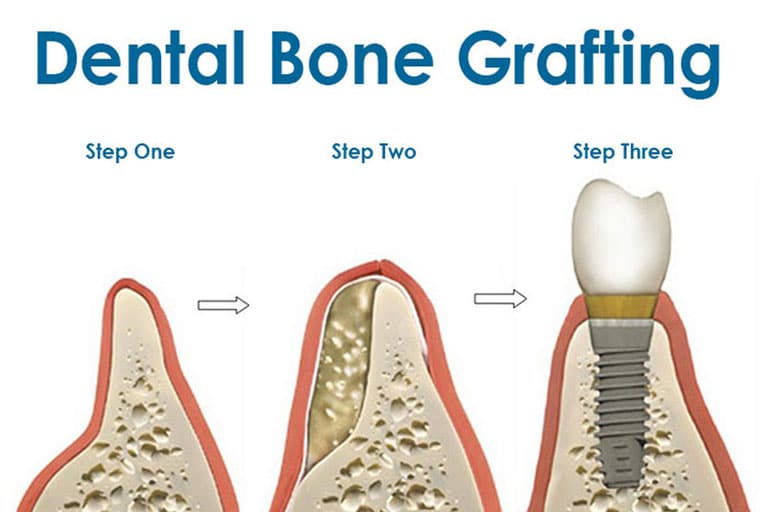 dental bone grafting irvine