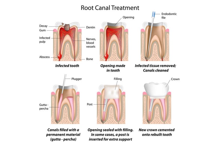 root canal treatment irvine