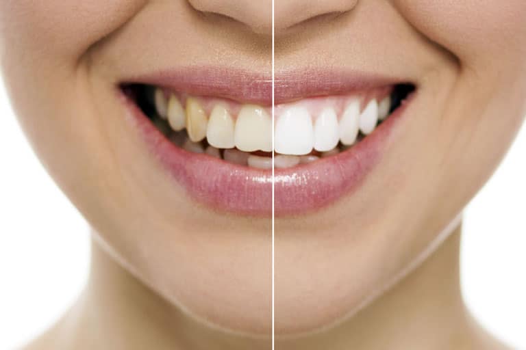 teeth whitening irvine